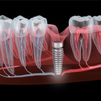 A dentist speaking to a couple about dental implants